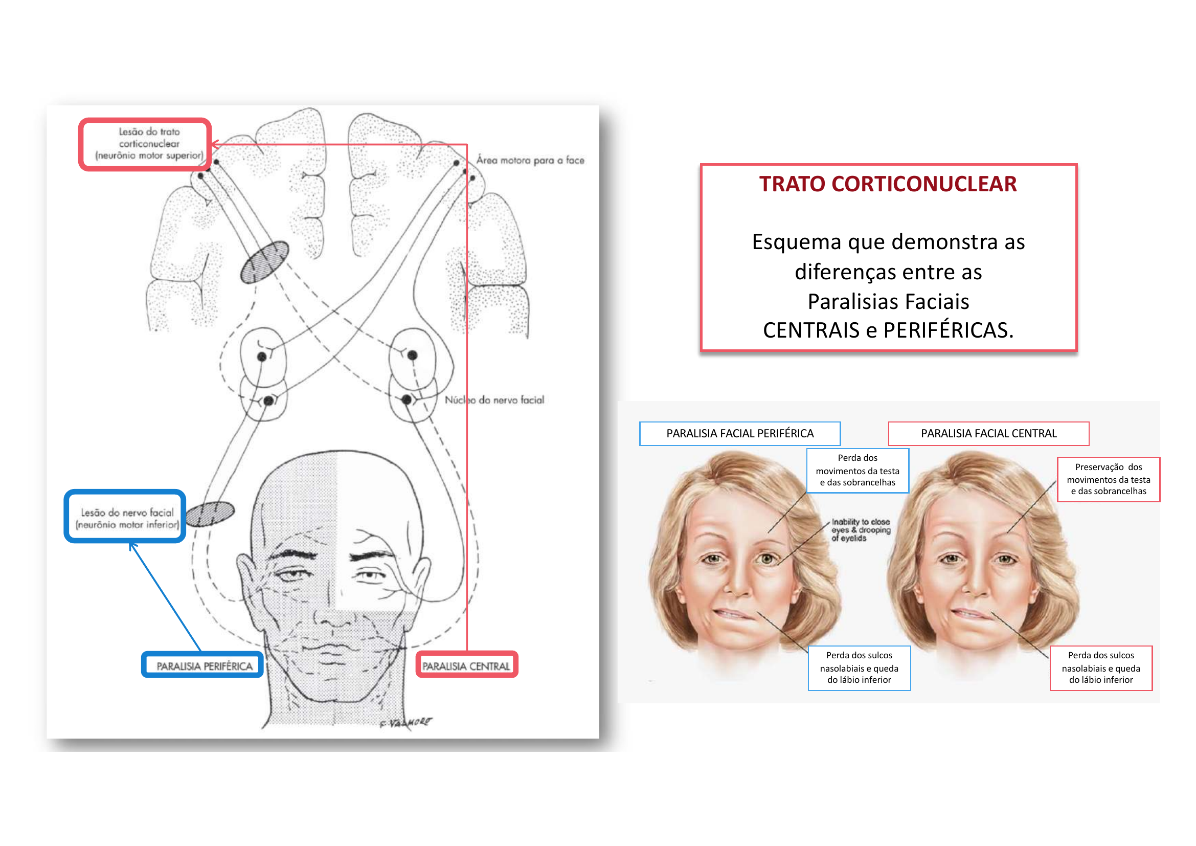 Paralisia Facial Central vs Periférica