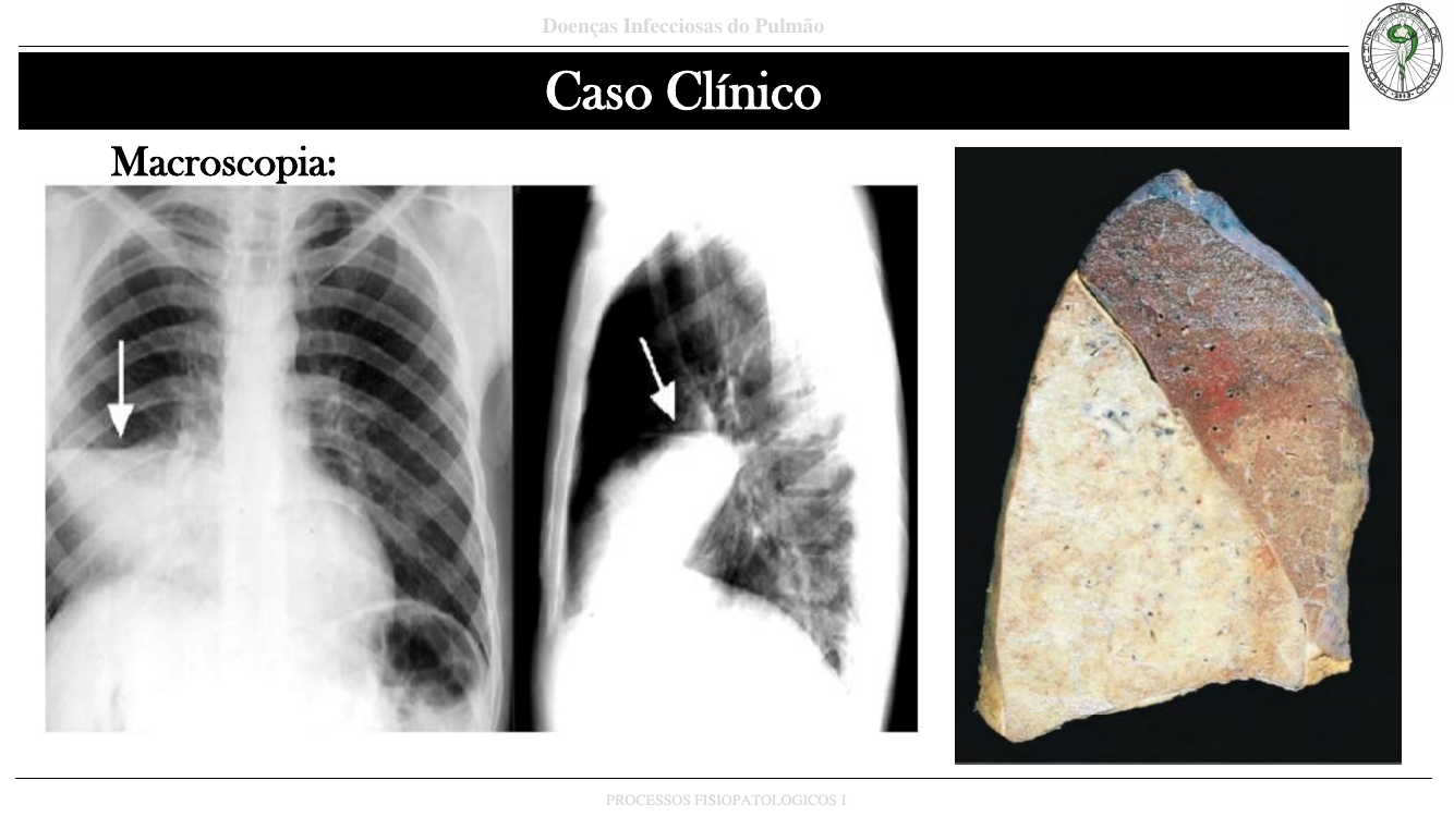 Macroscopia do caso 1 - consolidação lobar