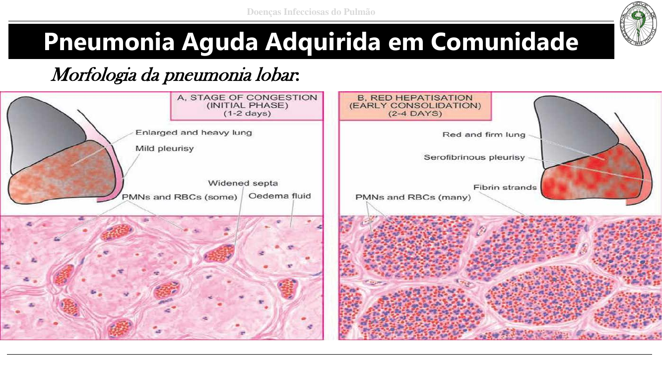 Fases congestão e hepatização vermelha