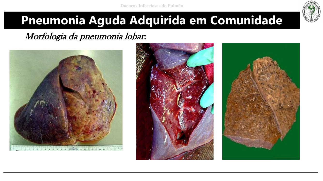 Macroscopia hepatização