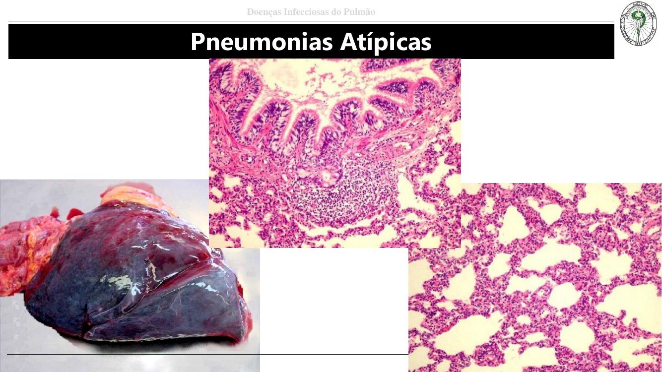 Pneumonia atípica - macro e micro