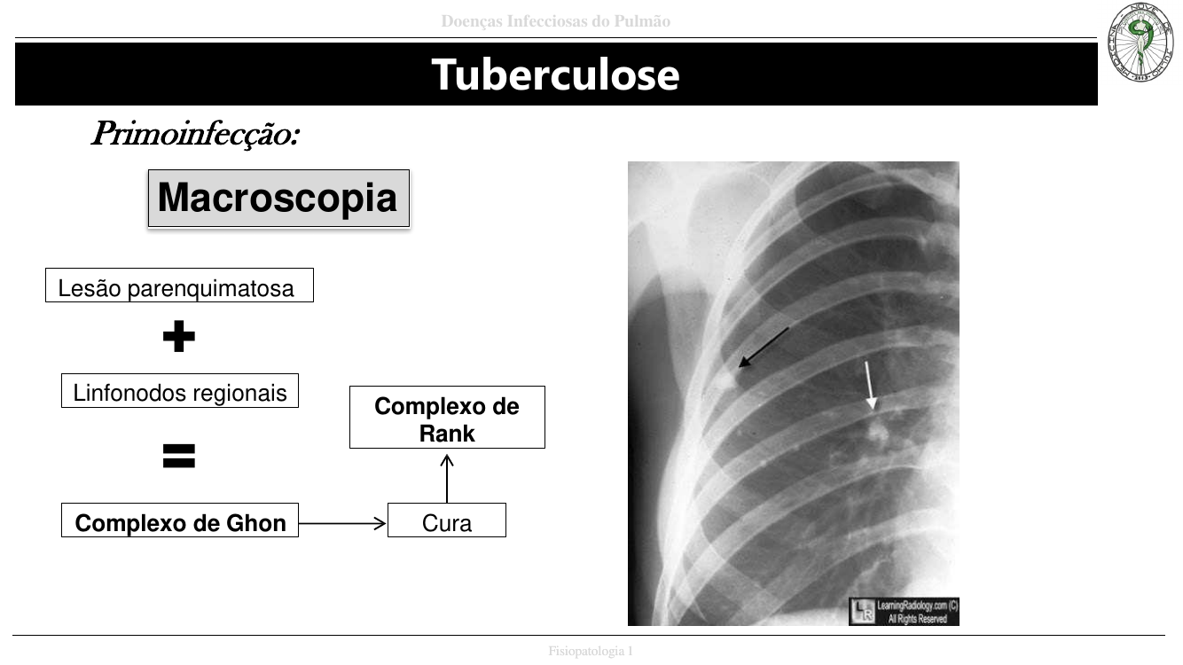 Complexo de Ghon e Ranke