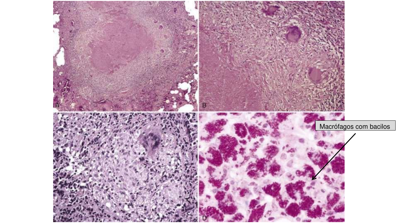 Granulomas com bacilos