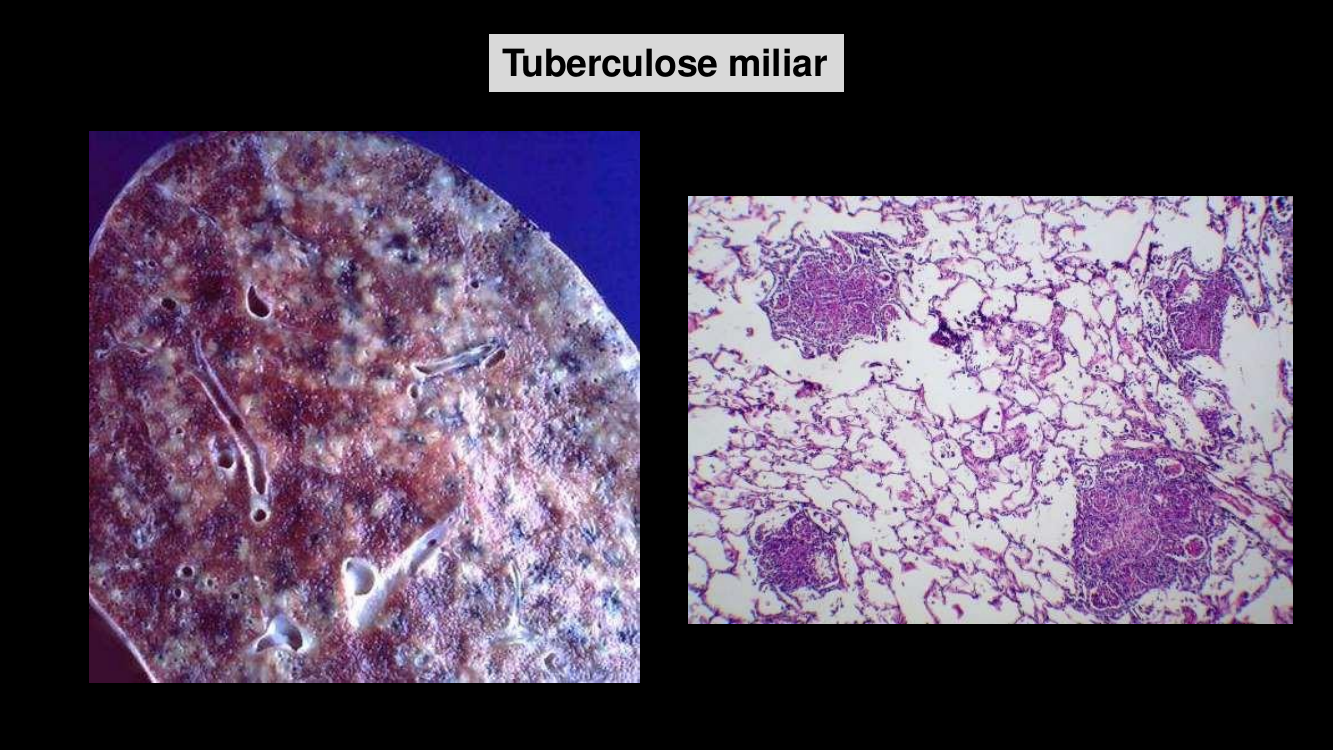 TB miliar pulmão e micro