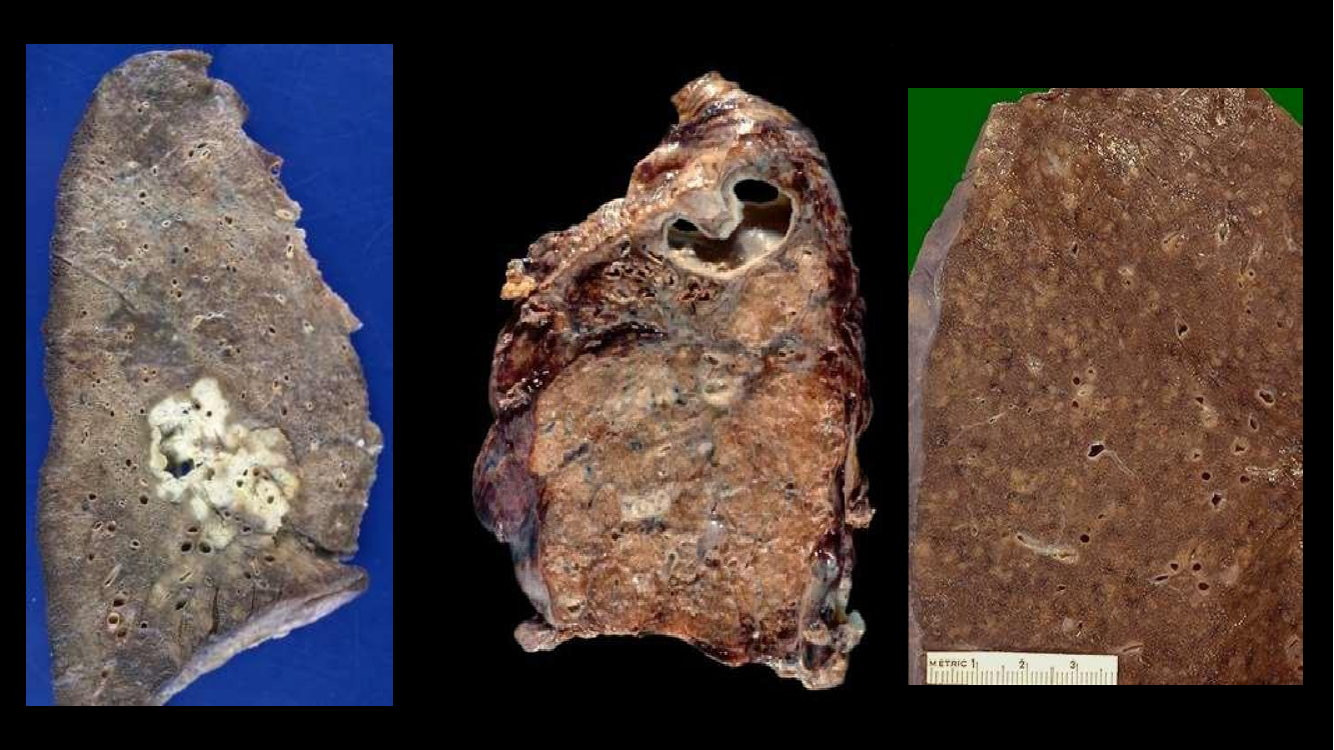 Macroscopia TB miliar diversos órgãos