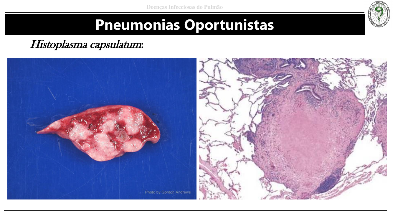 Histoplasma capsulatum