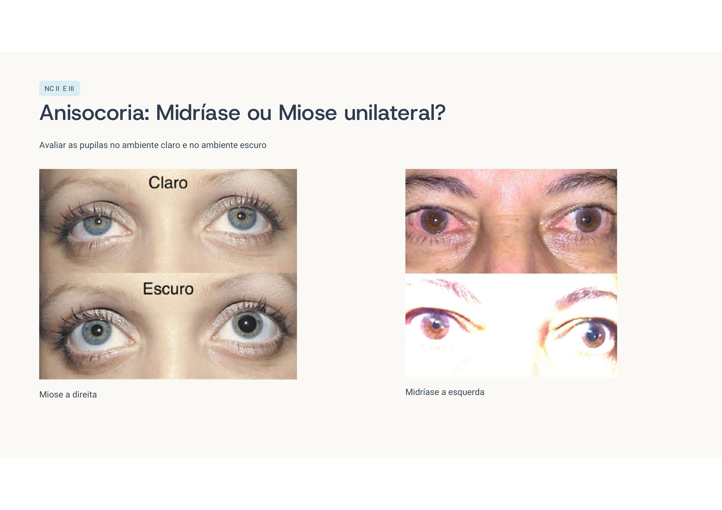 Anisocoria claro x escuro