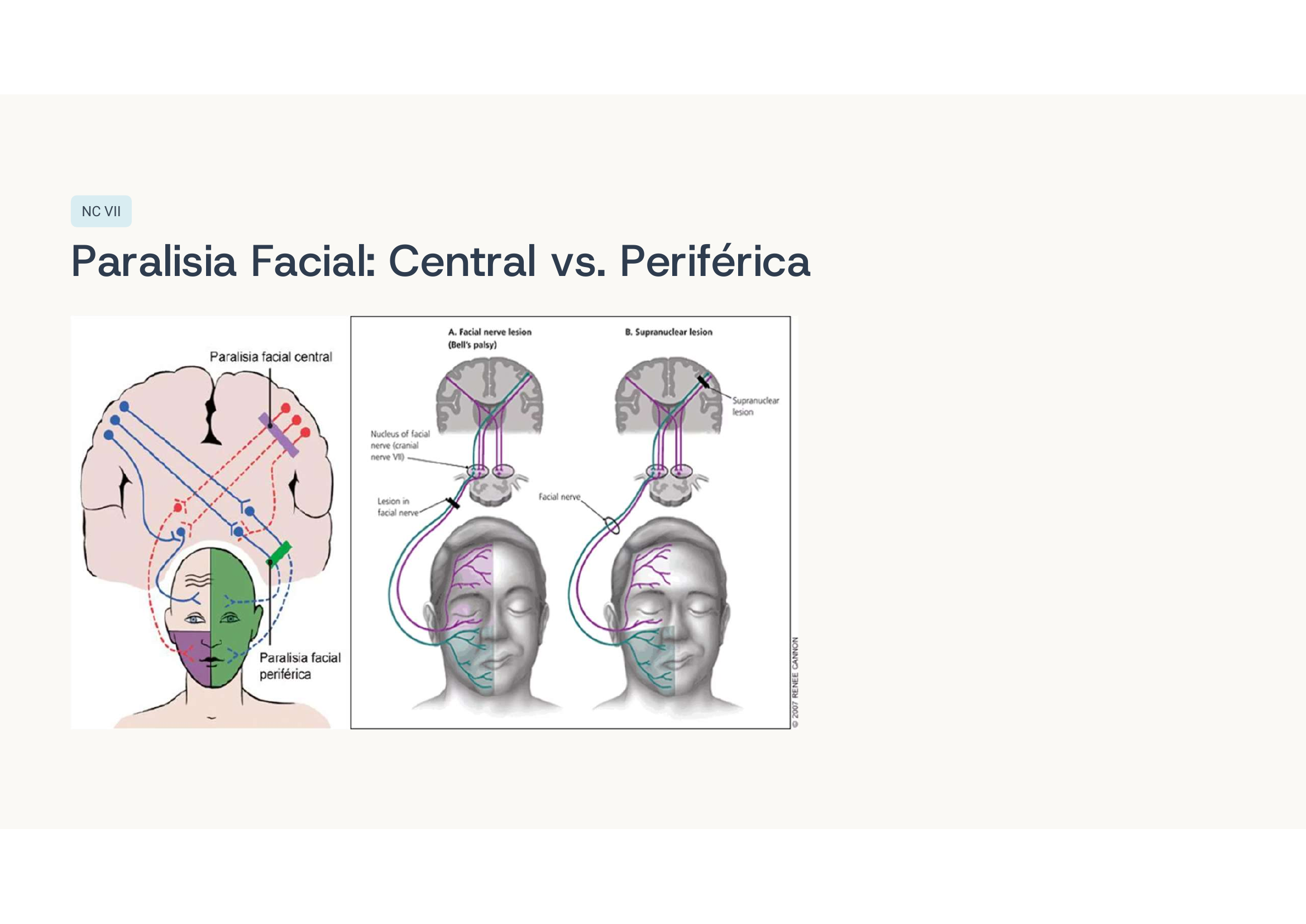 Paralisia facial central x periférica
