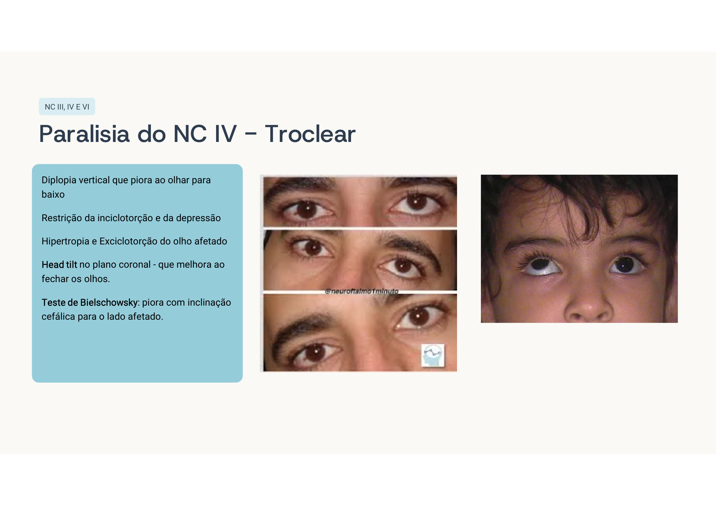 Paralisia do NC IV